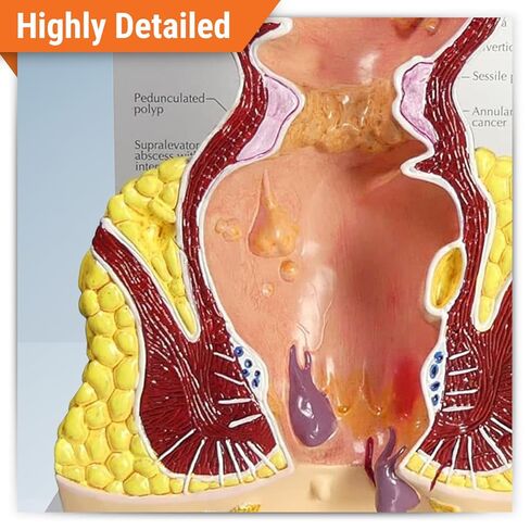 GPI Anatomicals - Human Rectum Model with Common Pathologies, Replica for Anatomy and Physiology Education, Anatomy Model for Doctor's Offices and Classrooms, Medical Learning Resources in Kuwait