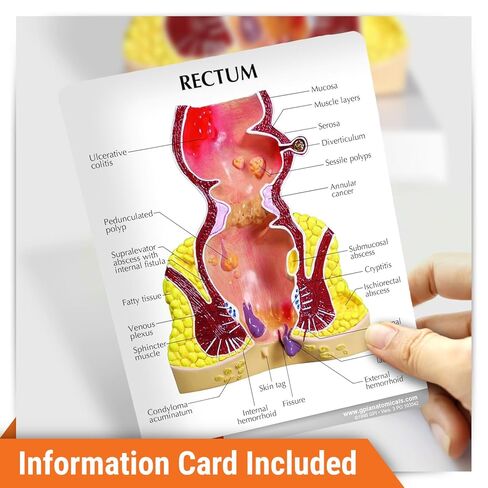 GPI Anatomicals - Human Rectum Model with Common Pathologies, Replica for Anatomy and Physiology Education, Anatomy Model for Doctor's Offices and Classrooms, Medical Learning Resources in Kuwait
