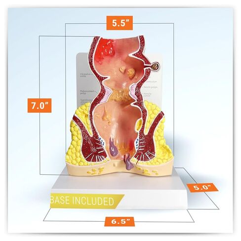 GPI Anatomicals - Human Rectum Model with Common Pathologies, Replica for Anatomy and Physiology Education, Anatomy Model for Doctor's Offices and Classrooms, Medical Learning Resources in Kuwait