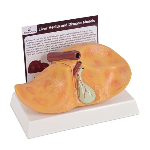 Silicone Alcoholic Fatty Liver Model, Pathological Liver Replica for Medical Training & Liver Disease Education in Kuwait