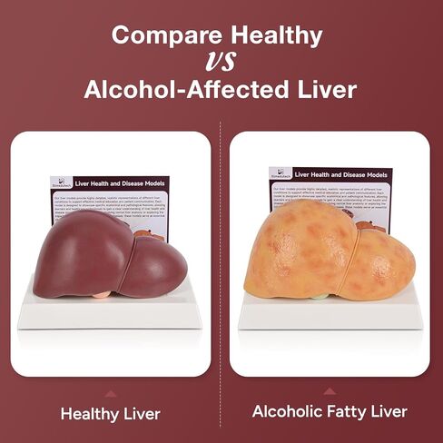 Silicone Alcoholic Fatty Liver Model, Pathological Liver Replica for Medical Training & Liver Disease Education in Kuwait