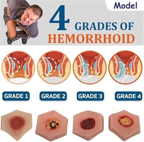 EDSORE Wound Care, Four Stages of Pressure Ulcers, Simulated Nursing Model, Medical Training Practice in Saudi Arabia