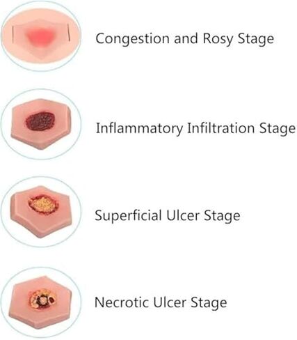 EDSORE Wound Care, Four Stages of Pressure Ulcers, Simulated Nursing Model, Medical Training Practice in Saudi Arabia