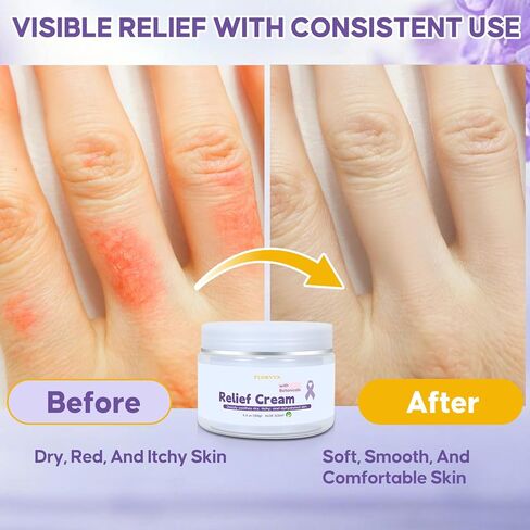 Radiation Burn Relief Cream, Soothing Moisture Cream for Sensitive Patients, Dry & Irritated Skin, Nourishing Hydration, Gentle Daily Skincare Cream for Calming Redness & Discomfort, Aloe Vera Scent in Saudi Arabia