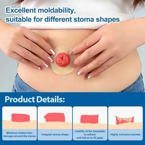 20 حزمة من حلقات حاجز الفغرة، أختام فغر الغروانية المائية، مستلزمات فغرة موسع الجلد المرن بسمك 2 مم، حلقات تمديد الجلد المانعة للتسرب لأكياس فغر القولون فغر اللفائفي in Kuwait