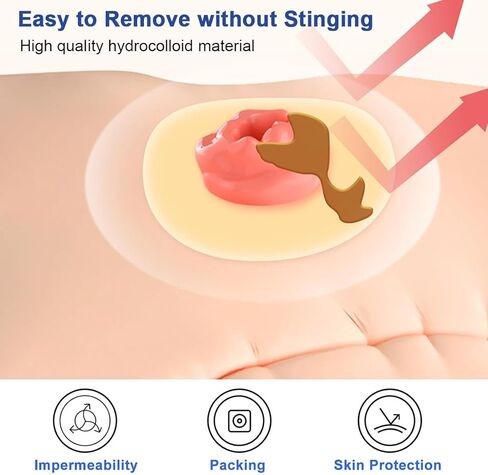 6 عبوات من حلقات حاجز الفغرة بسُمك 2 مم وشريط غرواني مائي قابل للتشكيل وأختام متماسكة لفغر القولون وفغر اللفائفي وأكياس فغر البول in Kuwait