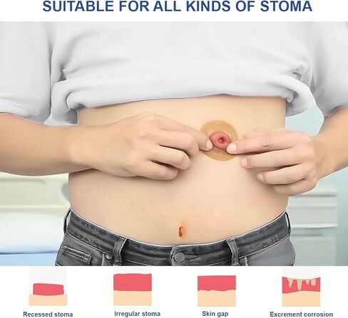 6 عبوات من حلقات حاجز الفغرة بسُمك 2 مم وشريط غرواني مائي قابل للتشكيل وأختام متماسكة لفغر القولون وفغر اللفائفي وأكياس فغر البول in Kuwait