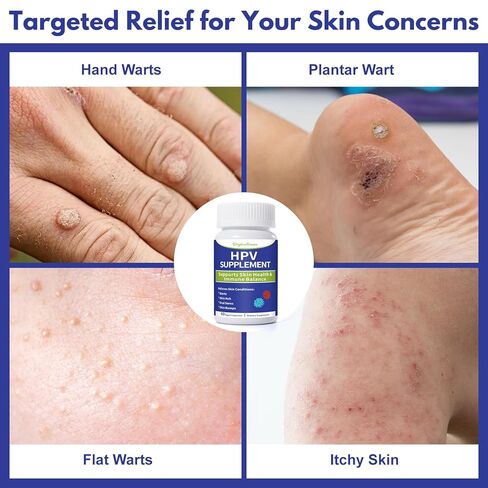 مكمل دعم الجلد لفيروس الورم الحليمي البشري - تركيبة عشبية لإزالة الثآليل والصدمات والقروح وحكة الجلد - يدعم صحة البشرة وتوازن المناعة - مع استراغالوس وإشنسا ونوني - 60 كبسولة نباتية NDC in Kuwait