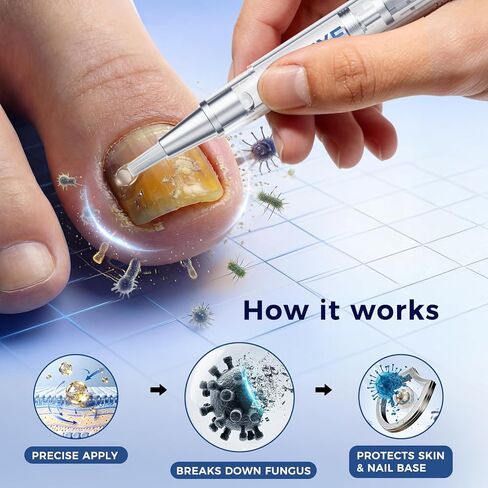قلم معالجة فطريات القدم وأظافر القدم للرياضيين المؤهلين من إدارة الغذاء والدواء الأمريكية - الحد الأقصى من مضادات الفطريات التي لا تحتاج إلى وصفة طبية مع 25% من حمض الأنديسيلينيك، أداة توزيع دقيقة لتخفيف الحكة والعناية بالأظافر in Kuwait