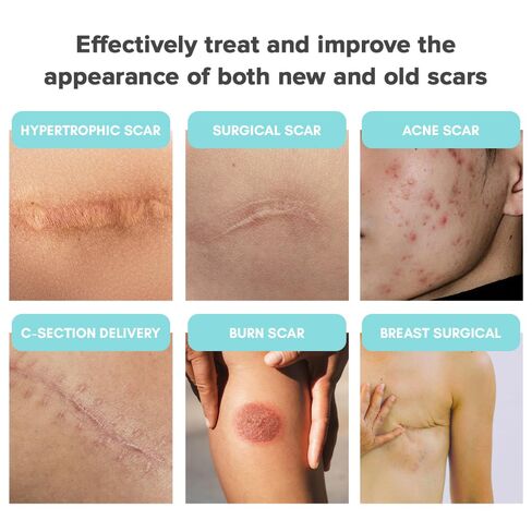 Silicone Scar Tape/Sheets for Surgical Scars, (1.6" x 59") Silicone Scar Removal Strips for Surgical, C-Section, Tummy Tuck, Keloid Scars Keloid Bump Removal (4cm x 1.5M) in Kuwait