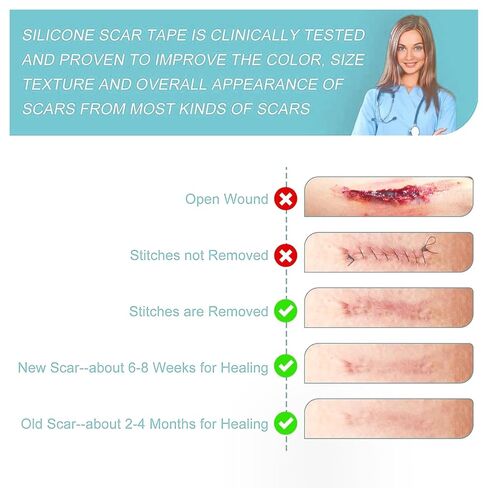 Silicone Scar Tape/Sheets for Surgical Scars, (1.6" x 59") Silicone Scar Removal Strips for Surgical, C-Section, Tummy Tuck, Keloid Scars Keloid Bump Removal (4cm x 1.5M) in Kuwait