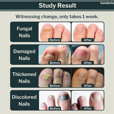 مصل مضاد للفطريات لعلاج فطريات القدم والأظافر بأقصى قوة مع تولنافتات 1% - محلول سريع الامتصاص لتخفيف الجلد والفطريات لدى الرياضيين - تركيبة غير دهنية (30 مل) in Kuwait