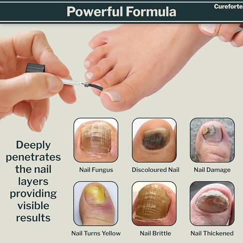 مصل مضاد للفطريات لعلاج فطريات القدم والأظافر بأقصى قوة مع تولنافتات 1% - محلول سريع الامتصاص لتخفيف الجلد والفطريات لدى الرياضيين - تركيبة غير دهنية (30 مل) in Kuwait