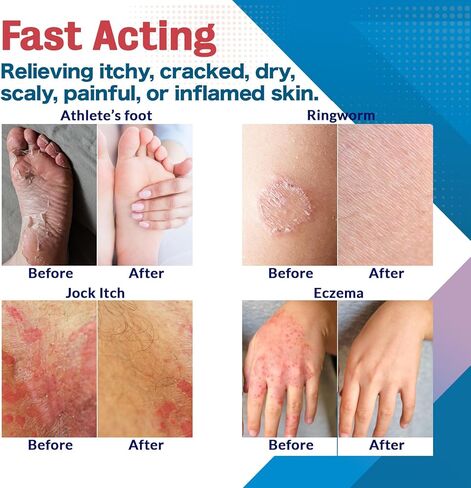 كريم مضاد للفطريات لالتهاب الجلد الدهني والتهاب الجريبات: مناسب لفروة الرأس والجسم، ويدعم التهاب الجلد حول الفم، وحب الشباب الفطري الخلفي، والقوباء الحلقية، وقدم الرياضي وحكة اللعب، 1 أونصة in Kuwait