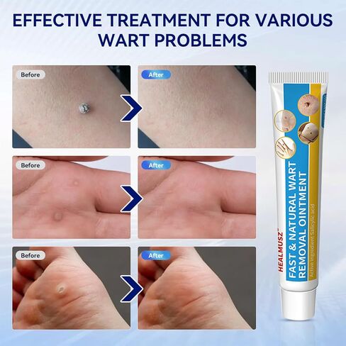 يحتوي مزيل الثآليل من هيلموس على 17% من حمض الساليسيليك لإزالة الطغوات الجلدية وكريم إزالة الثآليل الطبيعي سريع المفعول للثآليل الشائعة والثآليل الأخمصية والثآليل الأخرى في الجسم in Kuwait