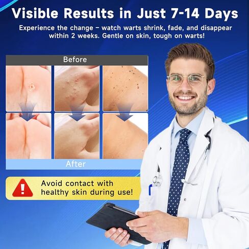 مزيل ثآليل حمض الساليسيليك سريع المفعول 20 جرام، مزيل قوي لمسامير القدم، مناسب للثآليل الأخمصية، وثآليل الذرة، والثآليل المسطحة، والثآليل الشائعة in Kuwait