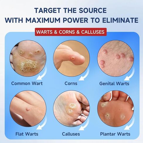 Fast Acting Wart Remover: with Salicylic Acid, Fast Acting Wart Freeze Off，for Plantar Wart, Common wart, Flat wart, and Corns.for Women and Men 30ML in Saudi Arabia