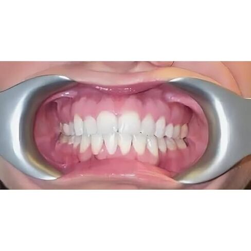 Dental Mouth Opener Metal Cheek Lip Retractor Double-Head Stainless Steel Ergonomic Design for Optimal Comfort - Autoclavable 10Pcs in Saudi Arabia