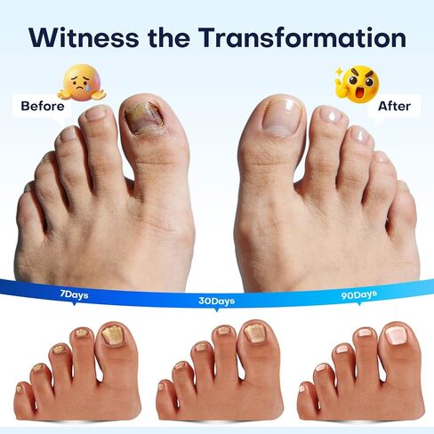 قلم فطريات أظافر القدم من فيلشور - علاج فطريات أظافر القدم بقوة إضافية، يحتوي على 25% من حمض الأنديسينويك وزيوت شجرة الشاي، بالإضافة إلى مكونات طبيعية أخرى، خفيف وغير مهيج - قلم فطريات الأظافر 5 قطع in Kuwait