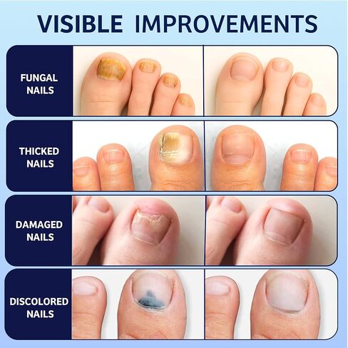 تجديد الأظافر الفطرية: 30% حمض الأنديسيلينيك، علاج قوي لفطريات أظافر القدم بالزيوت الطبيعية - ضمادة أظافر، مبرد أظافر وفرشاة للأظافر الغارزة في الجلد وتغير اللون، 30 مل in Kuwait