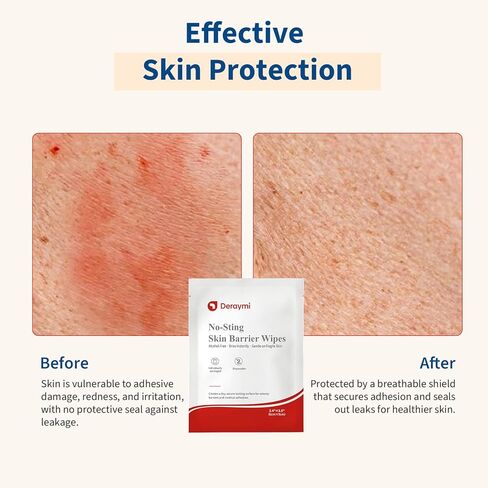 100 Pcs Skin Barrier Wipes, 2.4" x 3.5" Skin Prep Protective Wipes, No Sting Skin Adhesive Wipes to Create The Barrier Film Between Skin and Attachments, Ostomy Barrier Film Wipes (Alcohol Free) in Kuwait