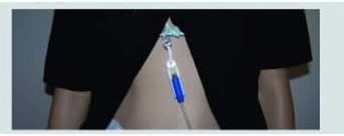Secureway Peritoneal Dialysis Day/Shower & Night/Exchange Catether Holder for Baxter Type valves (Black) in Saudi Arabia