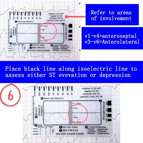 3 قطع مسطرة تخطيط القلب ذات 7 خطوات، مسطرة تخطيط القلب ذات 7 خطوات لتفسير تخطيط القلب/رسم القلب، أداة قياس بلاستيكية مسطرة تخطيط القلب، أداة قياس فرجار رسم القلب الشفاف، اتبع خطة من 7 خطوات، أداة محمولة بطاقة رسم القلب in Kuwait