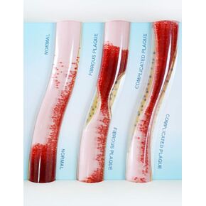 Low-Density Lipoprotein LDL Blood Vessel Model for Medical Patient Doctor Teaching