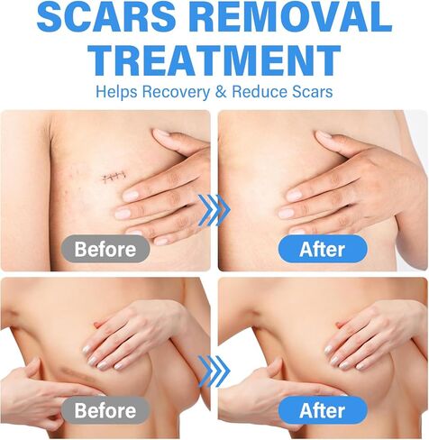 Silicone Scar Sheets - Medical Grade Silicone Scar Sheets for Breast - 4 Pair Reusable & Breathable Strips, Soft Post-Surgery Tape for Scar Prevention in Kuwait