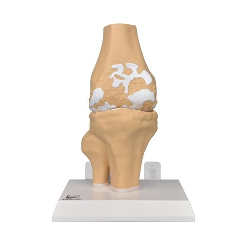 Human Osteoarthritis Knee Joint Anatomic Model, 1:1 Life-Size Skeleton Models for Medical Teaching Demonstration，Anatomy Model for Doctor's Office and Classrooms in Kuwait