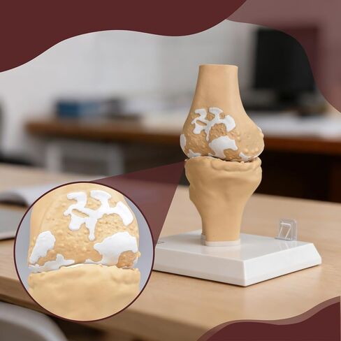 Human Osteoarthritis Knee Joint Anatomic Model, 1:1 Life-Size Skeleton Models for Medical Teaching Demonstration，Anatomy Model for Doctor's Office and Classrooms in Kuwait