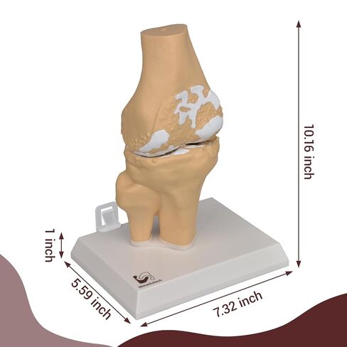 Human Osteoarthritis Knee Joint Anatomic Model, 1:1 Life-Size Skeleton Models for Medical Teaching Demonstration，Anatomy Model for Doctor's Office and Classrooms in Kuwait