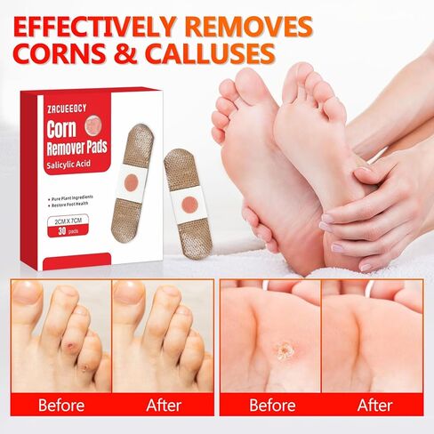 Wart Corn Remover Pads for Feet: 30 Pack 40% Salicylic Acid Extra Strength Treatment - Fast Effective Wart Corn Remover Bandages for Kids Adults Seniors Teens Athletes Runners Hikers Workers Men Women in Saudi Arabia