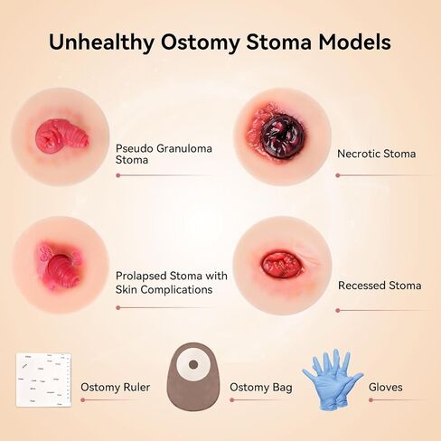 Sticky Unhealthy & Abnormal Stoma Simulation Models, Ostomy Care Practice Set, Stoma Care Training Kit for Nursing & Medical Education in Kuwait