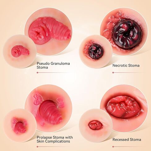 Sticky Unhealthy & Abnormal Stoma Simulation Models, Ostomy Care Practice Set, Stoma Care Training Kit for Nursing & Medical Education in Kuwait