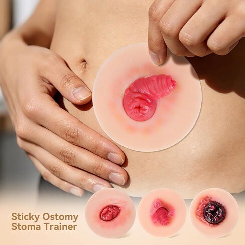 Sticky Unhealthy & Abnormal Stoma Simulation Models, Ostomy Care Practice Set, Stoma Care Training Kit for Nursing & Medical Education in Kuwait