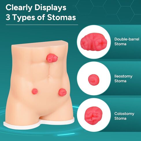 Stoma Demonstration Models Set of 2,Silicone Ostomy Simulator for Medical Teaching & Patient Education in Kuwait