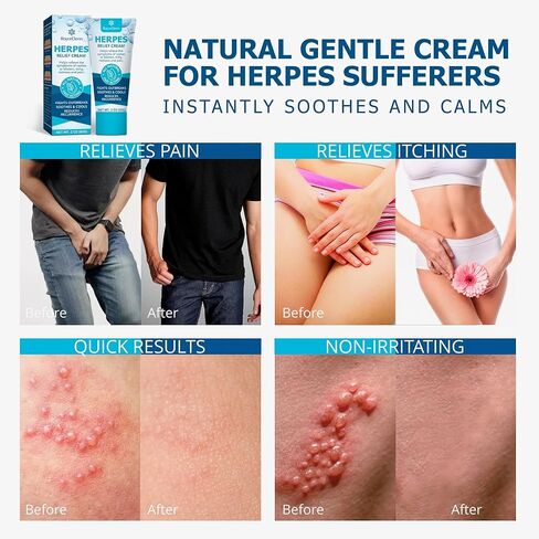 Roycederm Herpes Cream – Soothes Itching, Redness, Discomfort, and Sensitive Areas – Fast-Absorbing & Gentle Formula in Kuwait