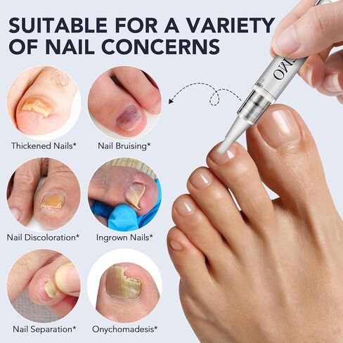 علاج فطريات أظافر القدم بقوة إضافية، قلم فطريات الأظافر، 25% حمض غير ديسيلينيك مع زيت شجرة الشاي المضاف، الجوجوبا، زيوت برعم القرنفل والصبار، محلول سريع المفعول لفطريات أصابع القدم والأظافر، 5 قطع in Kuwait