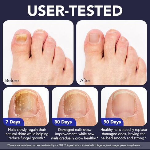 علاج فطريات أظافر القدم بقوة إضافية، قلم فطريات الأظافر، 25% حمض غير ديسيلينيك مع زيت شجرة الشاي المضاف، الجوجوبا، زيوت برعم القرنفل والصبار، محلول سريع المفعول لفطريات أصابع القدم والأظافر، 5 قطع in Kuwait