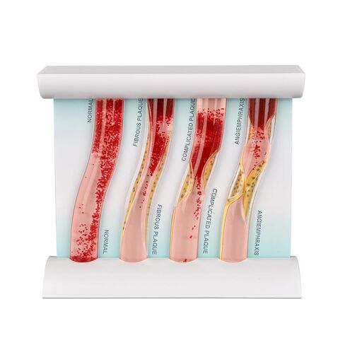 SimCoach Low-Density Lipoprotein LDL Blood Vessel Model for Medical Patient Doctor Teaching, Vascular Demonstration Training Tool, Large Size in Kuwait