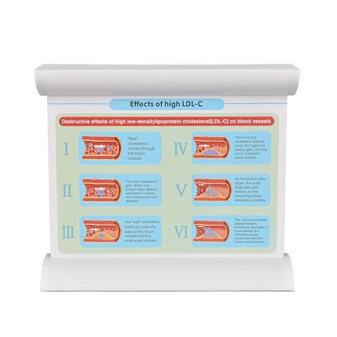 SimCoach Low-Density Lipoprotein LDL Blood Vessel Model for Medical Patient Doctor Teaching, Vascular Demonstration Training Tool, Large Size in Kuwait
