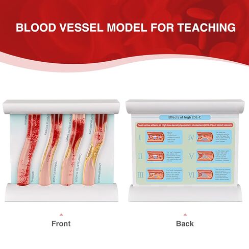SimCoach Low-Density Lipoprotein LDL Blood Vessel Model for Medical Patient Doctor Teaching, Vascular Demonstration Training Tool, Large Size in Kuwait