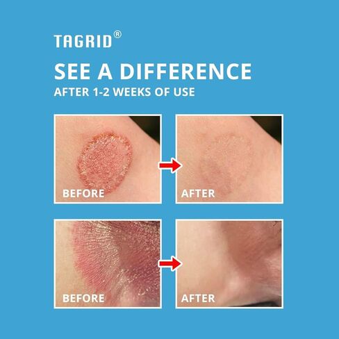 Antifungal Jock Itch Cream: Jock Itch Treatment for Men and Women - Extra Strength Antifungal Cream for Skin - Relief for Itchy Skin - Premium Anti-Fungal Relief - Relieves Itching Burning - 3.53 OZ in Kuwait