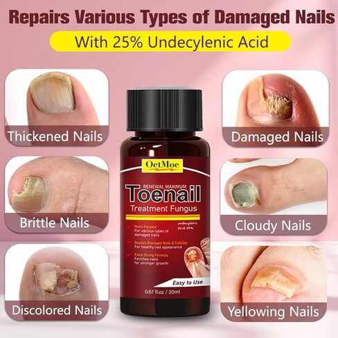 Toenail Fungus Treatment Extra Strength, Nail Fungus Treatment for Yellow, Thick, Discolored, Broken Nails, Ultimate Fungal Nail Repair, Make Nails Look Healthier Stronger, 2 Bottles in Saudi Arabia