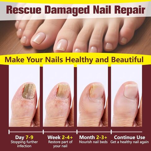 Toenail Fungus Treatment Extra Strength, Nail Fungus Treatment for Yellow, Thick, Discolored, Broken Nails, Ultimate Fungal Nail Repair, Make Nails Look Healthier Stronger, 2 Bottles in Saudi Arabia