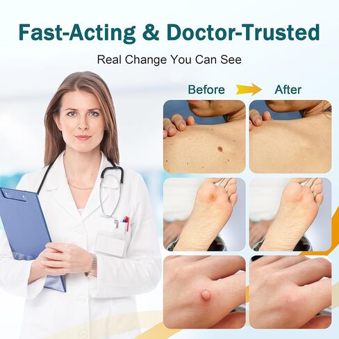 تجميد مزيل البث المزيل من 1 أوقية مزيل الذرة للأصابع 15 ٪ مزيل ثؤلول حمض الساليسيليك من أجل ثؤلول أخمصي ، ثؤلول مشتركة ، ثؤلول مسطحة ، الذرة ، الكالس in Kuwait