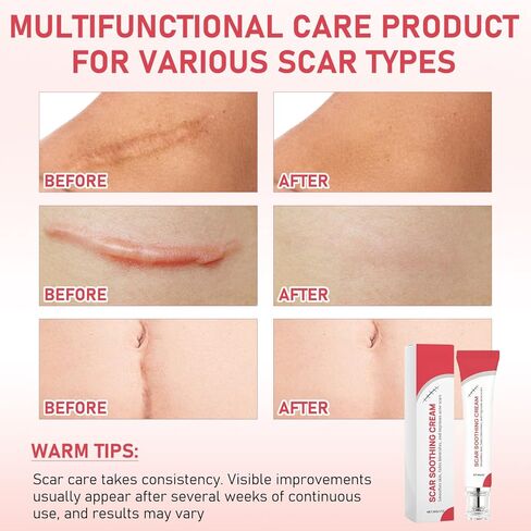 كريم مهدئ للندبات وكريم تنعيم للندبات، يساعد على تحسين المظهر، ويقلل الاحمرار، تركيبة خفيفة الوزن وغير دهنية (قطعتان) in Kuwait