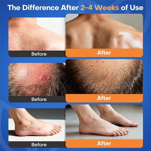 Antifungal Cream for Athletes Foot Jock Itch Ringworm Seborrheic Dermatitis Folliculitis Tinea Miconazole 2% Skin Fungus Relief Anti Fungal Athletes Foot Treatment for Humans 3.4 oz, 100g in Saudi Arabia