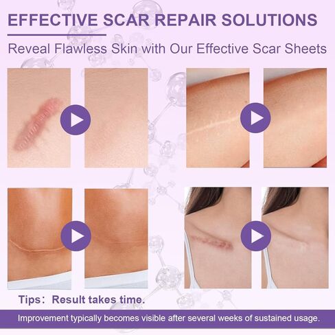 Silicone Scar Sheets, Advanced Medical Silicone Scar Tape(1.6"x 60"Roll-1.5M), Professional Grade Scar Removal Strip for Surgery, Tummy, Mouth, Face, C Section, Burn, Keloid, Acne Scars etc in Saudi Arabia